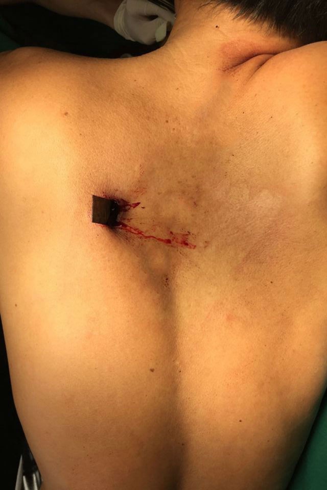 Lưỡi dao 6cm đâm xuyên lưng thấu tới ngực người đàn ông - Ảnh 1.