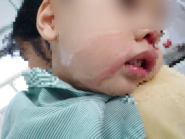 Mẹ bất cẩn nhỏ nhầm axit vào mũi con trai 2 tuổi - Ảnh 1.