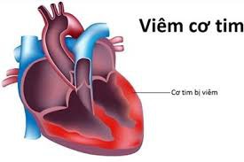 Hình minh họa về bệnh viêm cơ tim.