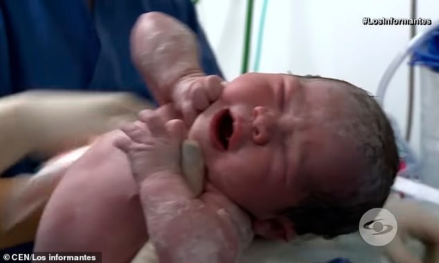 Đỡ đẻ cho một sản phụ xong, bác sĩ chết điếng người khi nhìn thấy một thai nhi khác đã hình thành tay chân trong bụng bé gái mới sinh - Ảnh 3.