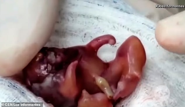 Đỡ đẻ cho một sản phụ xong, bác sĩ chết điếng người khi nhìn thấy một thai nhi khác đã hình thành tay chân trong bụng bé gái mới sinh - Ảnh 4.