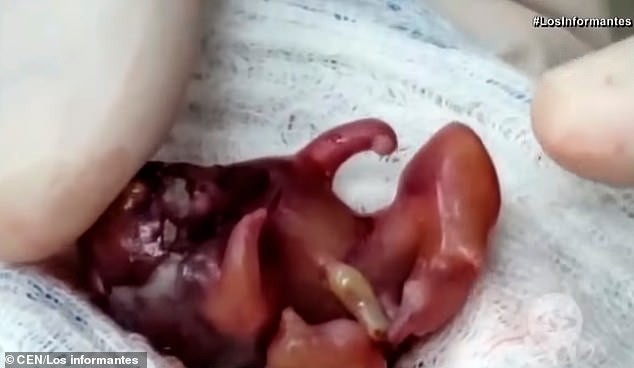 Đỡ đẻ cho một sản phụ xong, bác sĩ chết điếng người khi nhìn thấy một thai nhi khác đã hình thành tay chân trong bụng bé gái mới sinh - Ảnh 4. Đỡ đẻ cho một sản phụ xong, bác sĩ chết điếng người khi nhìn thấy một thai nhi khác đã hình thành tay chân trong bụng bé gái mới sinh - Ảnh 4.