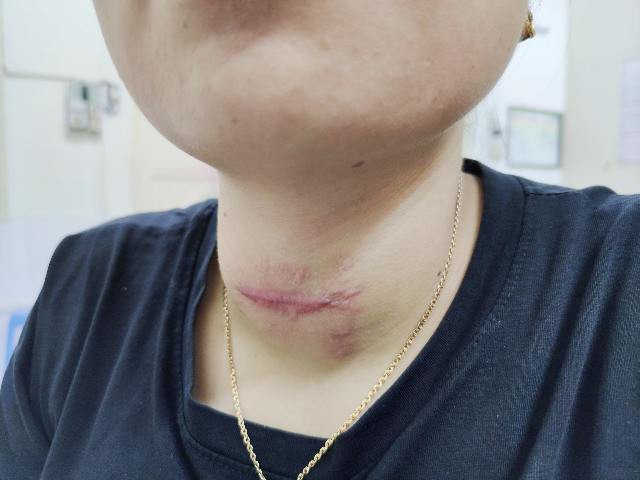 Thầy lang chữa bướu cổ khiến một phụ nữ nhiễm trùng nghiêm trọng phải cấp cứu - Ảnh 2. Thầy lang chữa bướu cổ khiến một phụ nữ nhiễm trùng nghiêm trọng phải cấp cứu - Ảnh 2.