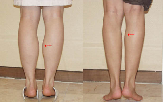 Hút mỡ đùi, bắp chân để sexy, nuột nà như người mẫu: Chị em nên biết quy trình thực hiện cùng những lưu ý quan trọng sau! - Ảnh 1.
