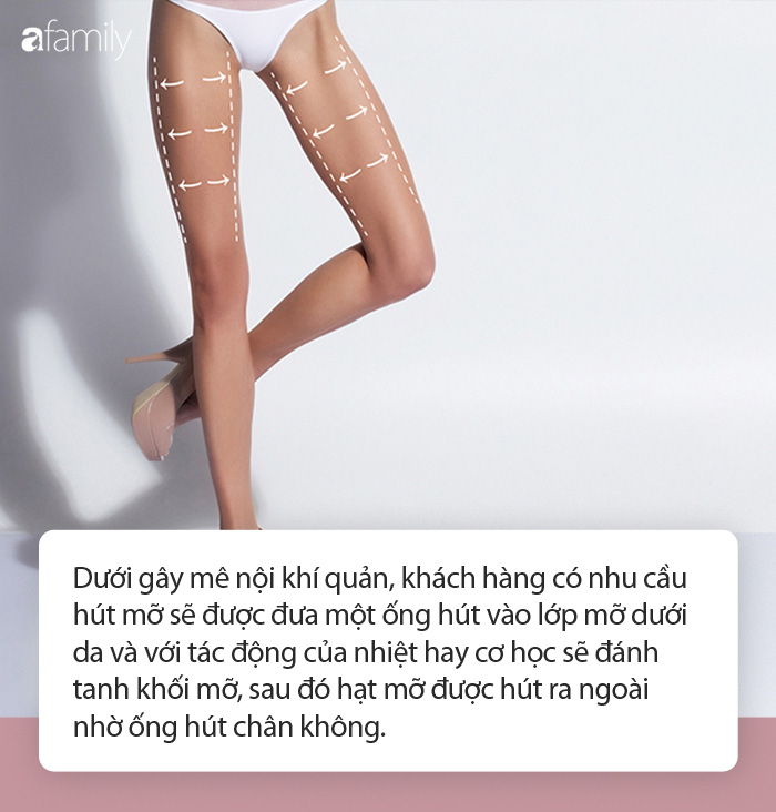 Hút mỡ đùi, bắp chân để sexy, nuột nà như người mẫu: Chị em nên biết quy trình thực hiện cùng những lưu ý quan trọng sau! - Ảnh 2.