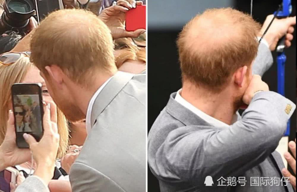 Hoàng tử Harry phải đi trị rụng tóc vì mảng hói trên đầu to gấp đôi kể từ khi cưới Meghan Markle  - Ảnh 1.