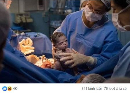 Hình ảnh em bé sơ sinh &quot;lườm xắt xéo&quot; bác sĩ khiến cư dân mạng được một trận cười thả ga - Ảnh 1.