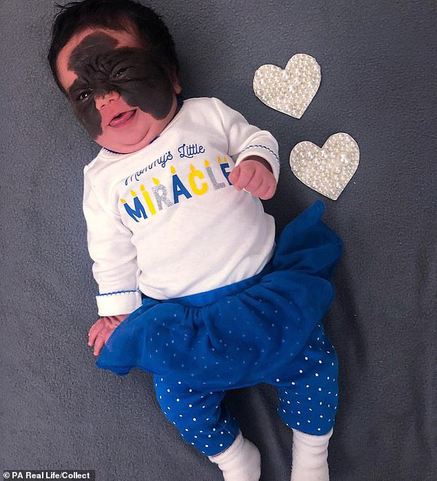 Con gái chào đời với vết bớt đen khổng lồ trên mặt, bị người đời trù ẻo là quái vật nhưng bố mẹ chỉ cần một hành động khiến ai cũng phải "cứng họng" - Ảnh 1.