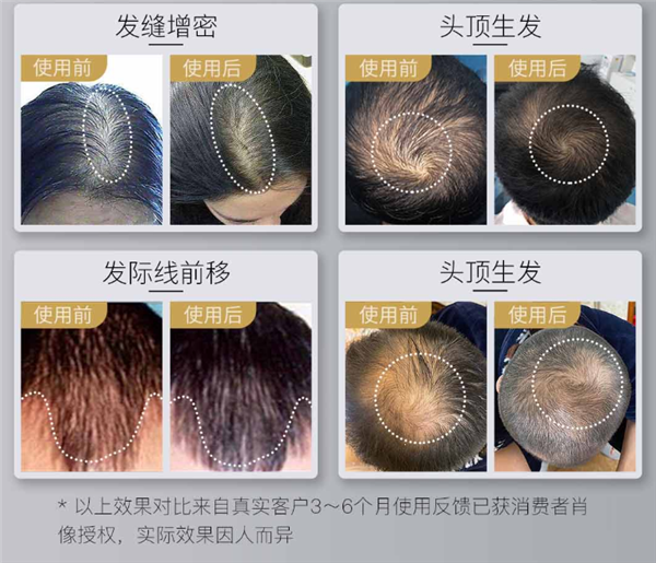 Xiaomi ra mắt mũ kích thích mọc tóc cho người bị hói, giá 4.9 triệu đồng - Ảnh 3.
