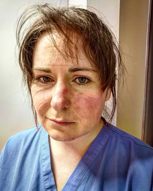 Nữ y tá xinh đẹp chia sẻ hình ảnh gương mặt biến dạng, đã đi qua &quot;địa ngục&quot; sau 65 tiếng làm việc và lời khẩn cầu gây chấn động mạng xã hội - Ảnh 2.
