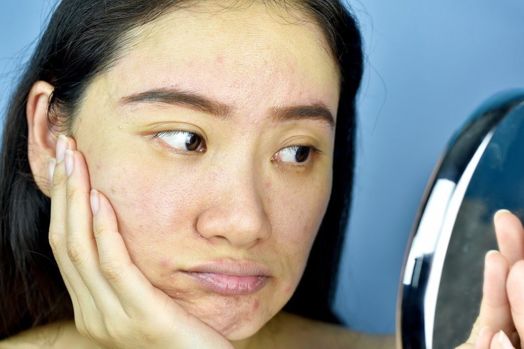 Chị em đua nhau "chữa" tóc hói, tóc rụng bằng Biotin, nhưng bác sĩ cảnh báo phải cẩn thận nếu không da dẻ lại lên mụn chi chít - Ảnh 4. Chị em đua nhau "chữa" tóc hói, tóc rụng bằng Biotin, nhưng bác sĩ cảnh báo phải cẩn thận nếu không da dẻ lại lên mụn chi chít - Ảnh 4.