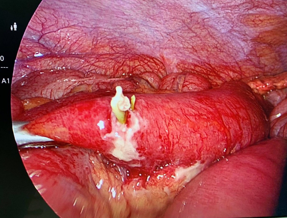 Nuốt nhầm xương cá khi ăn bệnh nhân phải cắt bỏ đoạn ruột non - Ảnh 1.