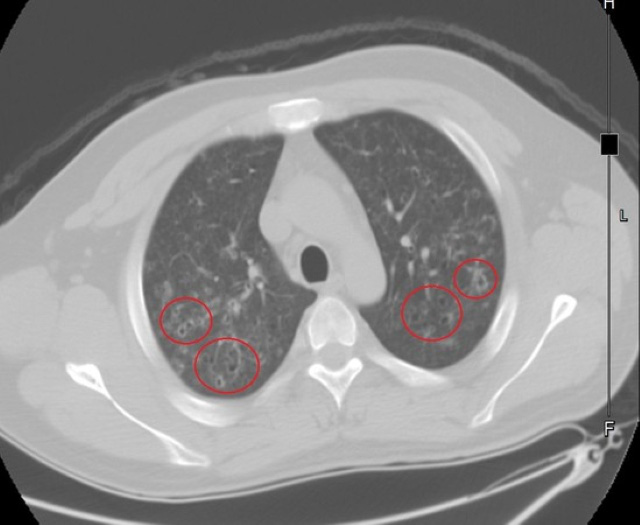 Chàng trai hút thuốc lá trong vòng 10 năm, phế quản giãn nở, mô phổi bị phá hủy, nhiều u nang bên trong hai lá phổi - Ảnh 1.