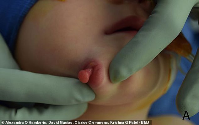 Vừa mới chào đời, bé gái đã khiến các bác sĩ kinh ngạc khi có đến 2 cái miệng trên mặt  - một bệnh lý vô cùng hiếm gặp - Ảnh 2.