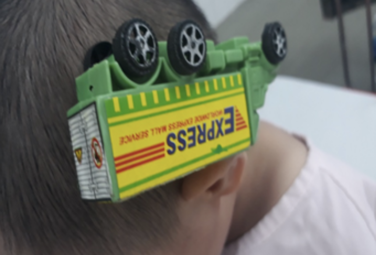 Hiểm họa khôn lường: Té ngã vào xe đồ chơi, bé trai 3 tuổi bị que sắt cắm thẳng vào đầu - Ảnh 1.