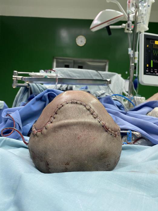 Phẫu thuật thành công cho bệnh nhi hẹp sọ bẩm sinh hiếm gặp - Ảnh 3.