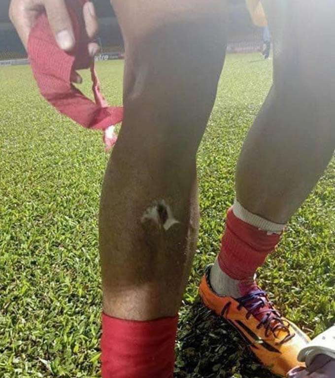 Cầu thủ V.League gãy chân kinh hoàng phẫu thuật thành công, cần 3 tháng để trở lại sân tập - Ảnh 2.