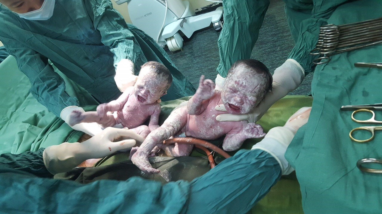 Hy hữu: Sản phụ Quảng Ninh sinh đôi, một trong hai bé còn nguyên trong túi ối - Ảnh 2.