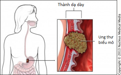 Ai có nguy cơ bị ung thư dạ dày: Nếu có một trong những yếu tố sau, cần cẩn thận! - Ảnh 3. Ai có nguy cơ bị ung thư dạ dày: Nếu có một trong những yếu tố sau, cần cẩn thận! - Ảnh 3.