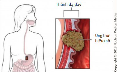 Ai có nguy cơ bị ung thư dạ dày: Nếu có một trong những yếu tố sau, cần cẩn thận! - Ảnh 3.