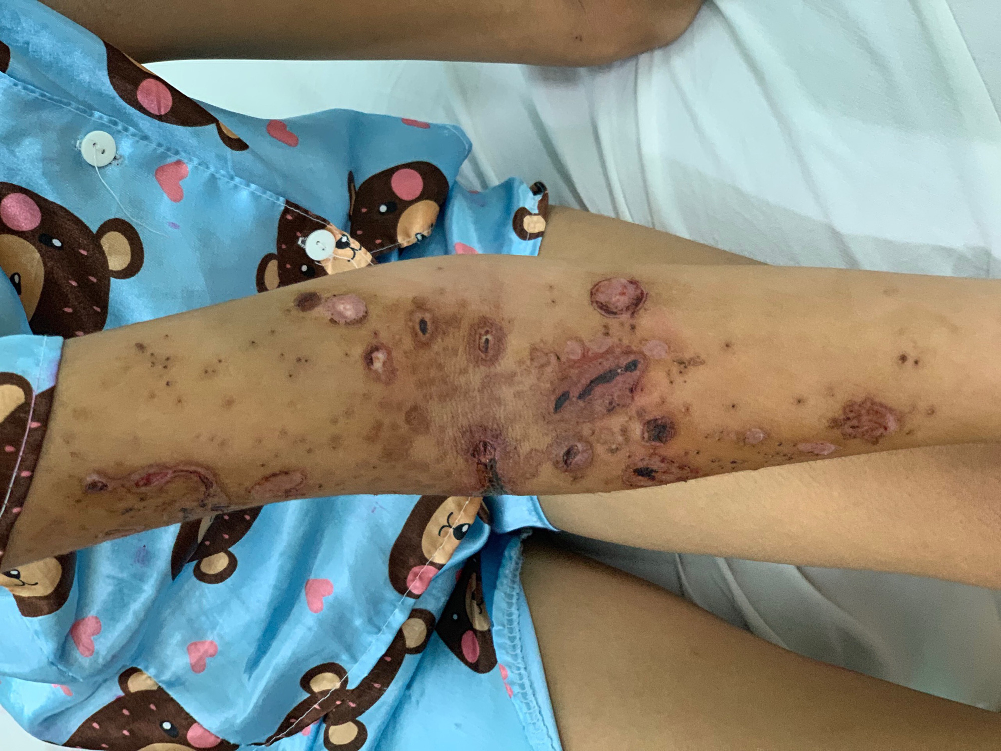 Tai nạn nguy hiểm: Tắm biển gần nhà, bé gái 8 tuổi ở Bình Thuận bị sứa &quot;cắn&quot; bỏng nặng - Ảnh 2.