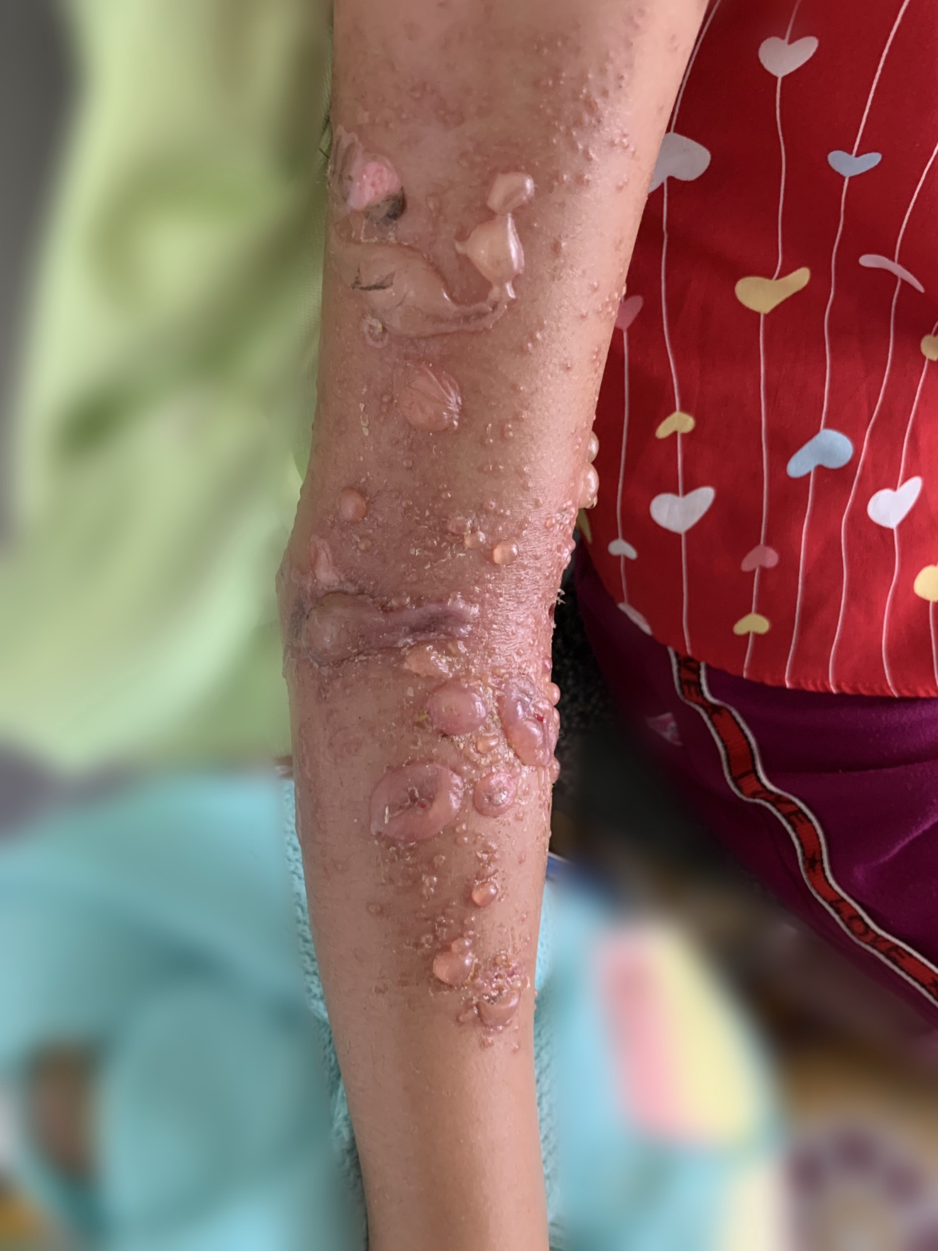 Tai nạn nguy hiểm: Tắm biển gần nhà, bé gái 8 tuổi ở Bình Thuận bị sứa &quot;cắn&quot; bỏng nặng - Ảnh 1.