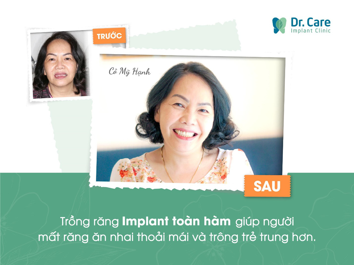 Hiểu đúng về trồng răng Implant toàn hàm, biết sớm ngày nào đỡ đắn đo ngày đó - Ảnh 1.