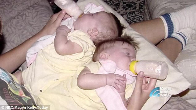 2 bé gái sinh đôi dính liền, cha mẹ mất 7 tháng mới đưa ra quyết định tách rời các con, 17 năm sau ai cũng gật đầu mãn nguyện khi nhìn thấy nụ cười trên khuôn mặt các em - Ảnh 3.