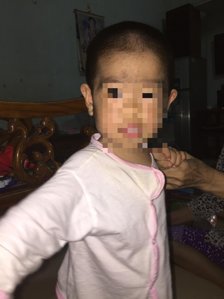 Người mọc toàn lông, bé gái 6 tuổi ở Vũng Tàu mắc bệnh hiếm gặp - Ảnh 1.