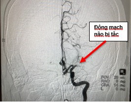 Cấp tốc vượt 150km đường biển và đường bộ kịp “giờ vàng” cấp cứu bệnh nhân đột quỵ - Ảnh 2.