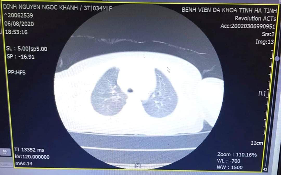 Bé 3 tuổi ho, khó thở không ngừng vì nút bấm điều khiển nằm trong khí quản - Ảnh 1. Bé 3 tuổi ho, khó thở không ngừng vì nút bấm điều khiển nằm trong khí quản - Ảnh 1.