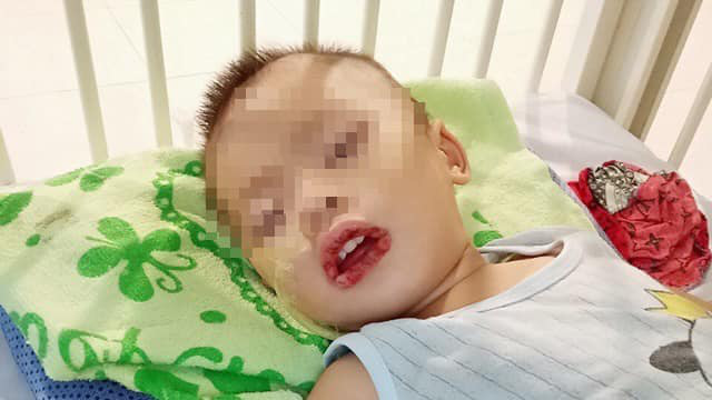 Gia đình bất cẩn, bé trai 21 tháng tuổi phải nhập viện do uống nước tẩy rửa bồn cầu - Ảnh 1.