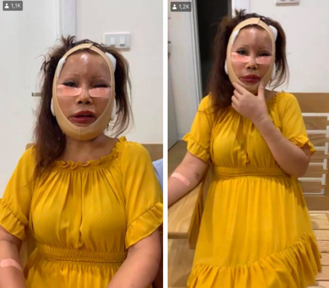 Cô dâu 63 tuổi ở Cao Bằng sau 2 tháng phẫu thuật căng da mặt, diện mạo khiến ai cũng đồng ý là dao kéo hỏng - Ảnh 1.
