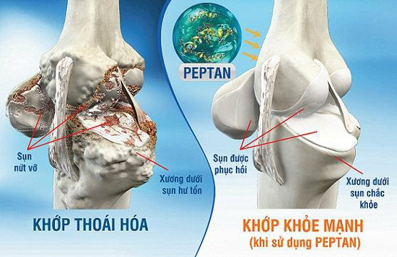 Người trẻ teo cơ – Người già suy tim chỉ vì xem thường viêm khớp - Ảnh 2.