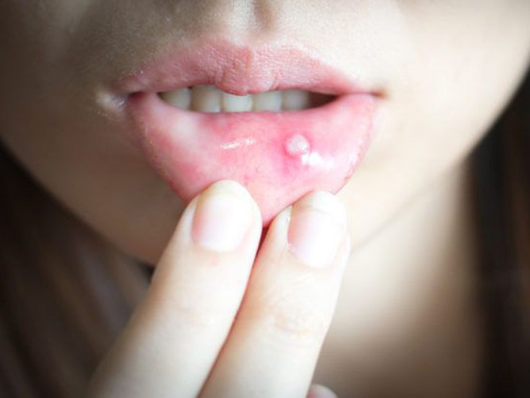 4 triệu chứng điển hình thường xuất hiện trong giai đoạn đầu của bệnh ung thư miệng, xem thử bạn có thuộc nhóm nào không - Ảnh 1.