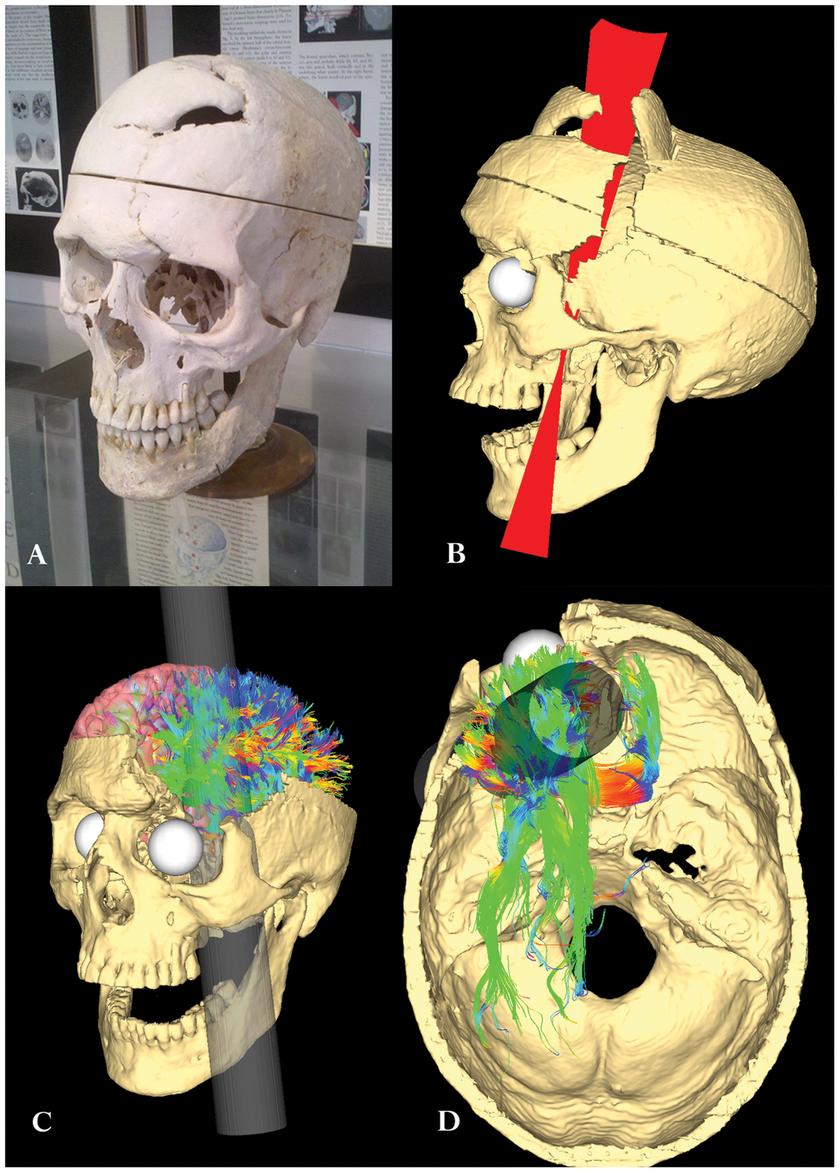 Phineas Gage và vụ tai nạn đã khai sinh ra khoa học thần kinh hiện đại - Ảnh 3.