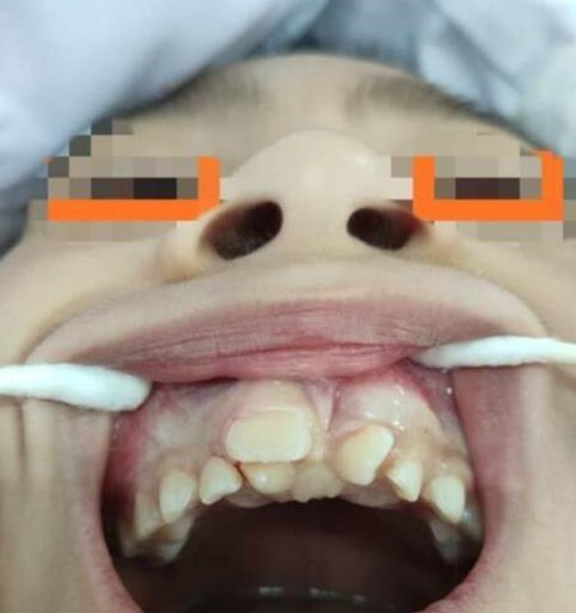 Bé trai 7 tuổi rưỡi vẫn không thay chiếc răng nào, gia đình đưa đi khám thì ngã ngửa khi nhận kết quả chụp X-quang từ bác sĩ - Ảnh 1.