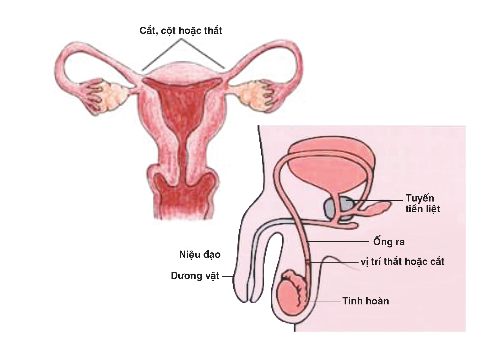 Bác sĩ Bệnh viện Phụ sản Hà Nội giải đáp thắc mắc của chị em: “Triệt sản có đẻ tiếp được không, có giảm ham muốn không?&quot; - Ảnh 1.