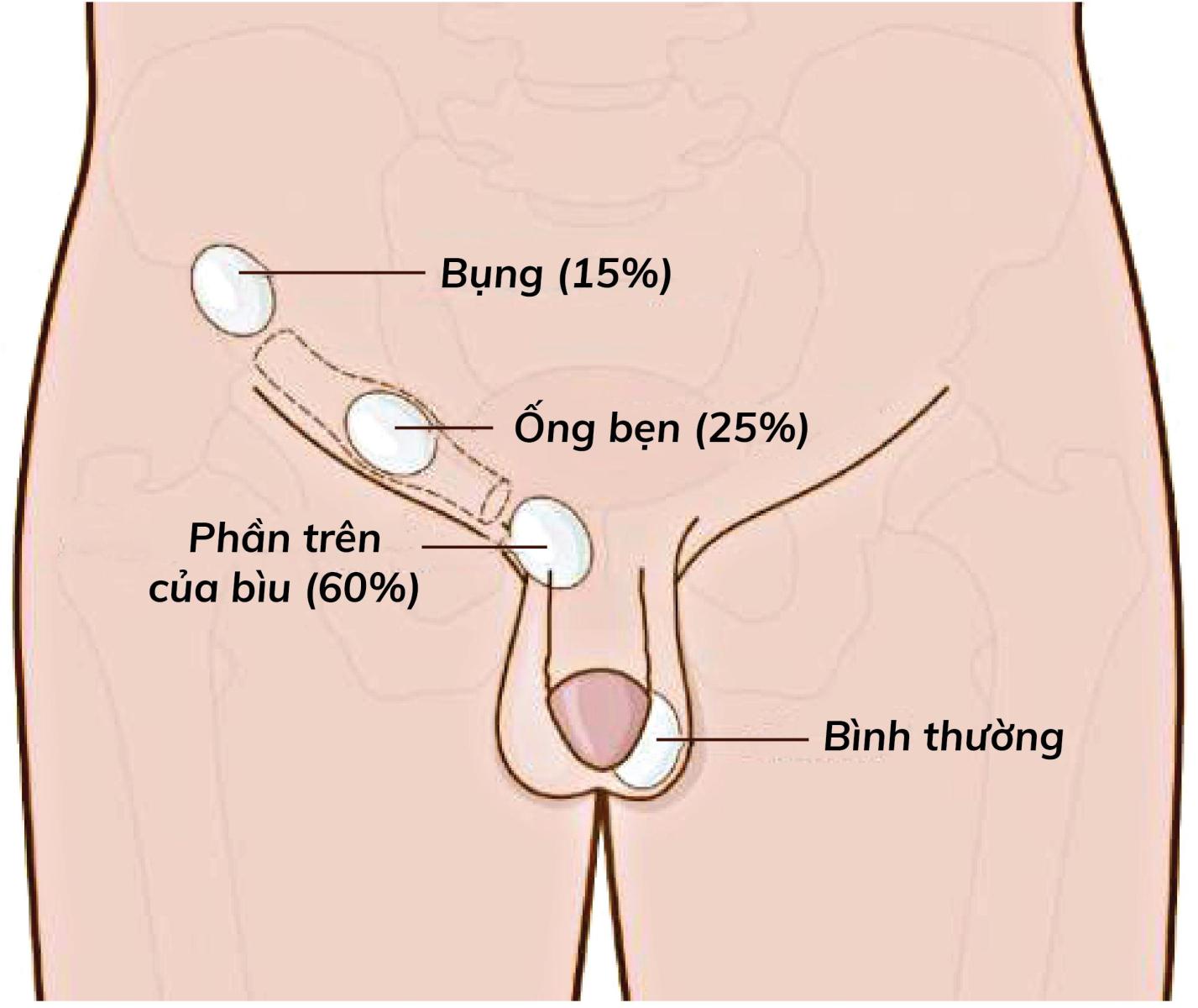 Bé bị ẩn tinh hoàn nay 15 tháng thì thăm khám ở đâu tốt? - Ảnh 2.