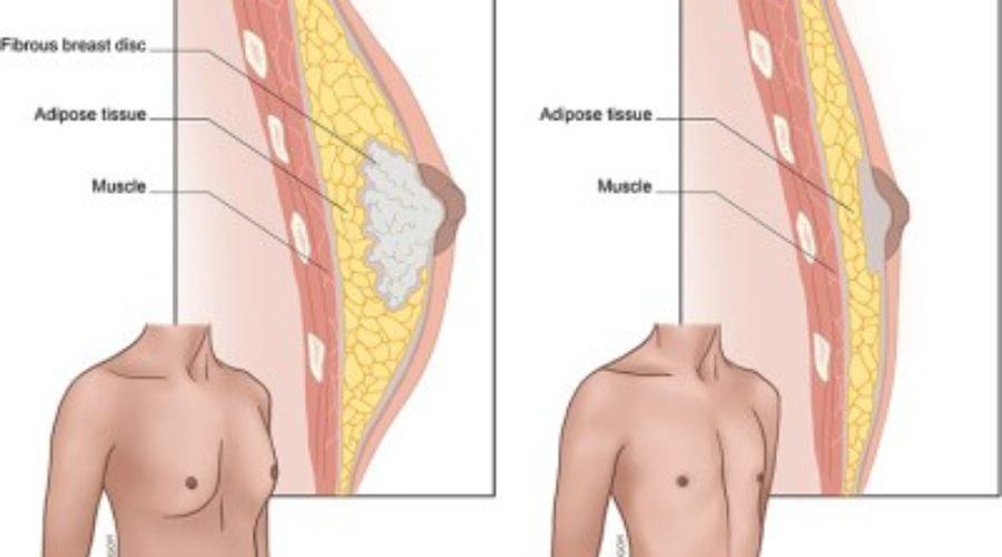 Mắc chứng vú to đàn ông, chàng trai tự ti, không dám nghĩ đến chuyện hẹn hò - Ảnh 2.