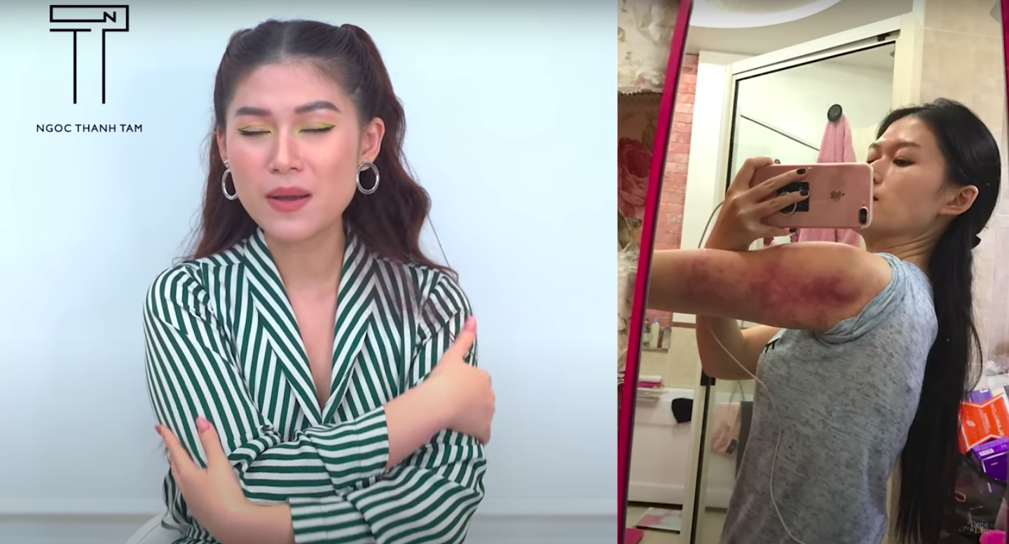 Con gái đại gia thủy sản tung ảnh sau khi hút mỡ bắp tay: Làm xong nhìn tôi như bị ai hành hạ, đánh đập - Ảnh 3.