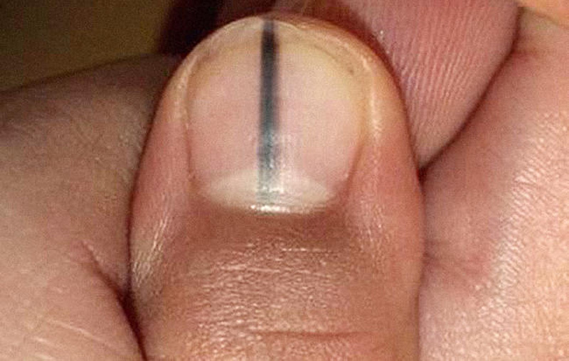 Những dấu hiệu bất thường về móng tay bạn không nên bỏ qua - Ảnh 4.