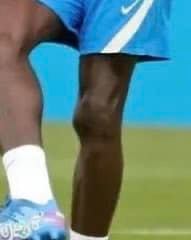 Đầu gối của Umtiti biến dạng thấy rõ sau nhiều ca chấn thương dai dẳng - Ảnh 1.