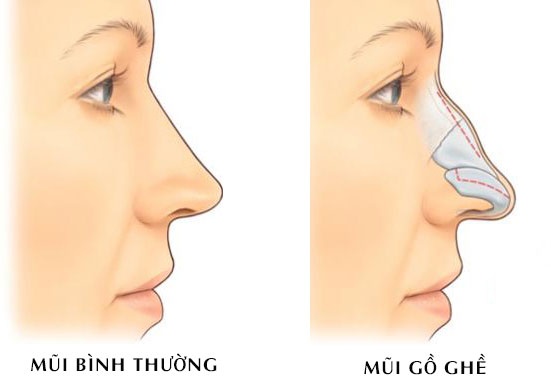 Không phải cứ mũi tẹt mới cần nâng mũi, người có dáng mũi này cũng nên &quot;cải tạo&quot; để tướng mạo đẹp chuẩn! - Ảnh 5.