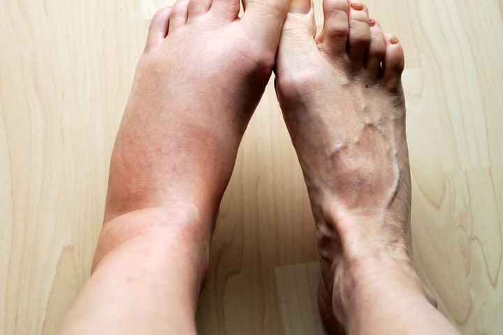 Nhìn bàn chân đoán bệnh, có 4 điểm bất thường trên bàn chân, cần đi khám thận khẩn cấp - Ảnh 4.