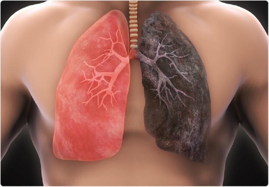Bác sĩ nhắc nhở: Nhận thấy 4 điều bất thường này ở tay thì có thể phổi đang “kiệt quệ”, nặng hơn có thể dẫn đến ung thư - Ảnh 1.
