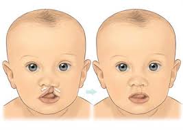 Phẫu thuật sứt môi, hở hàm ếch: Từ lưu ý đến giá cả, nơi nên thực hiện được chuyên gia chia sẻ tường tận - Ảnh 7.