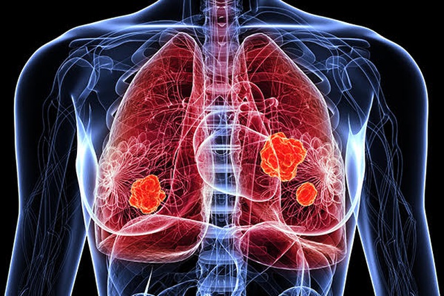 Đau vai, cổ đi khám phát hiện ung thư phổi: Bác sĩcảnh báo thói quen nhanh đến gần ung thư - Ảnh 1.
