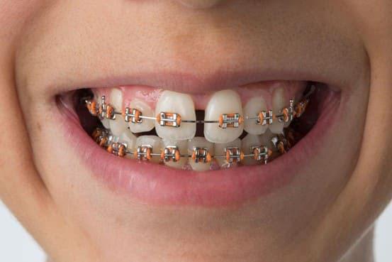 4 lưu ý cần nhớ khi chăm sóc răng dành riêng cho “hội đang niềng răng” - Ảnh 1.