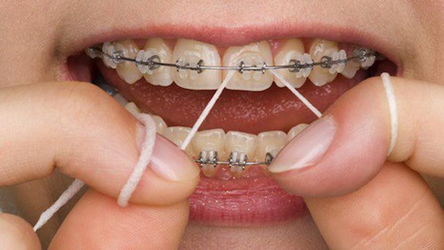 4 lưu ý cần nhớ khi chăm sóc răng dành riêng cho “hội đang niềng răng” - Ảnh 3.